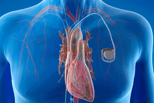 pacemakers