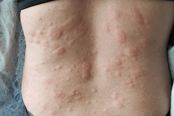 allergy