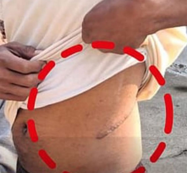 farmer-kidney-chandrapur