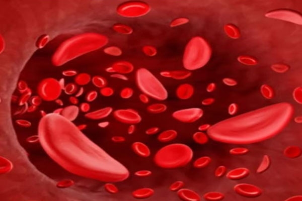 Gondia sickle cell campaign, Arunoday health initiative, sickle cell screening Gondia