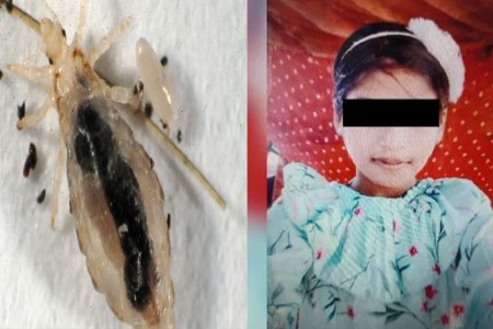 अरे देवा...१२ वर्षांच्या मुलीचा उवांमुळे दुर्दैवी मृत्यू