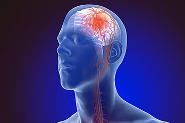 ब्रेन स्ट्रोक