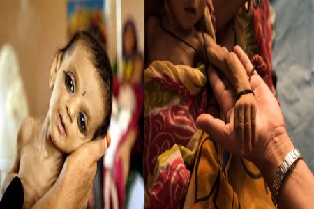 भारतातील बालकांचे कुपोषण 'गंभीर श्रेणीत'
