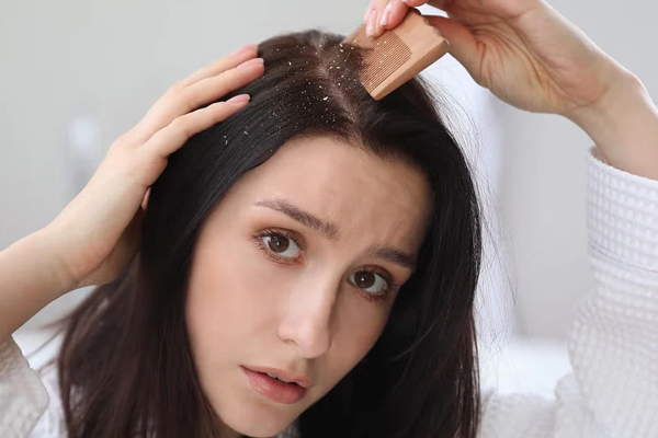 केसांमधील कोंडा 