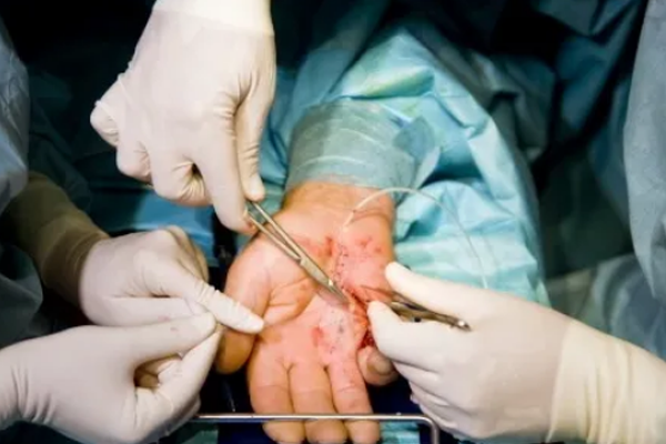मायक्रोव्हॅस्युलर शस्त्रक्रियेमुळे कापलेला हात 