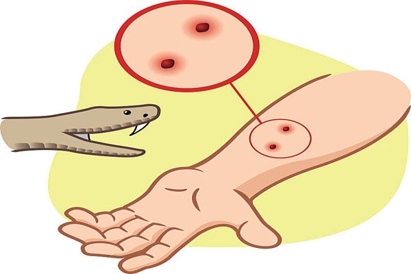 snakebite