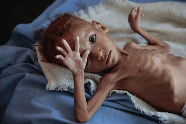 malnourished children